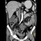 Peritoneal dialysis, complication, fluid collection, gigantic, before: CT - Computed tomography